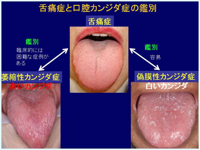 喉 に カビ が 生える 病気