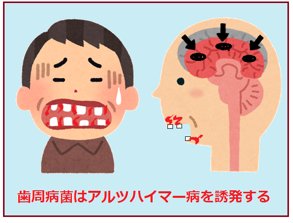 歯周病菌がアルツハイマーの進行を加速させる