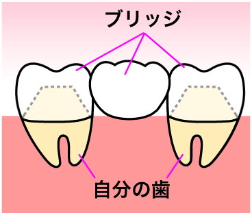 歯を失った後はどうなるの？!②