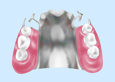 金属床義歯（保険外診療）