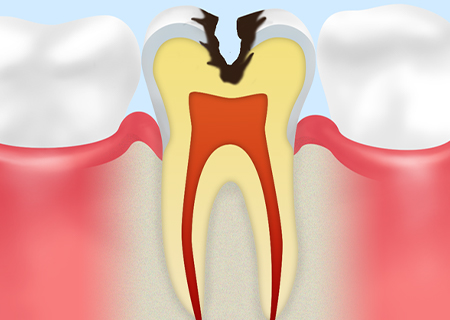 Step03　C2（象牙質の虫歯）