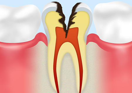 Step04　C3（神経まで冒された虫歯）