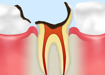 Step05　C4（末期の虫歯）