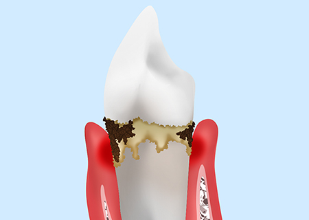Step02　初期歯周炎